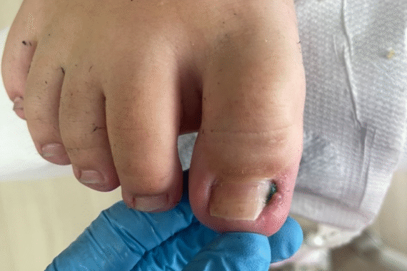 https://pedichiuramedicalabacau.ro/wp-content/uploads/2025/10/unghie-incarnata_-570x380.png